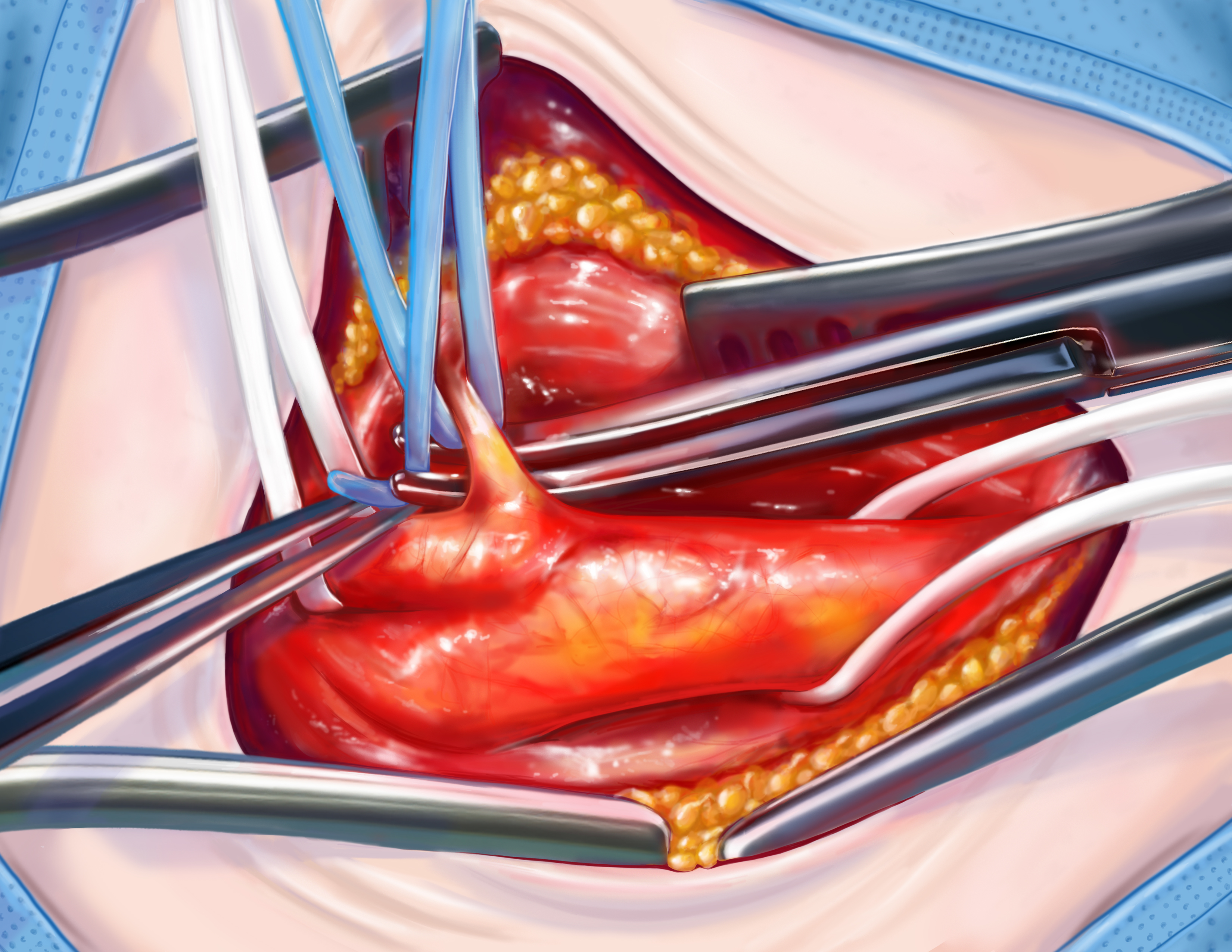 Carotid Endarterectomy